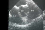 Cardiac ultrasound