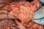 Retained swab in abdomen