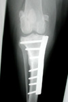 X-ray of Bone Plate