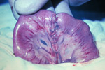 Inverted sutured gut