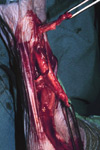 Lacerated tendon