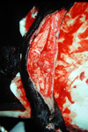 Large open wound