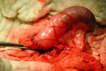 sutured large intestine