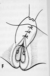 Gambee suture